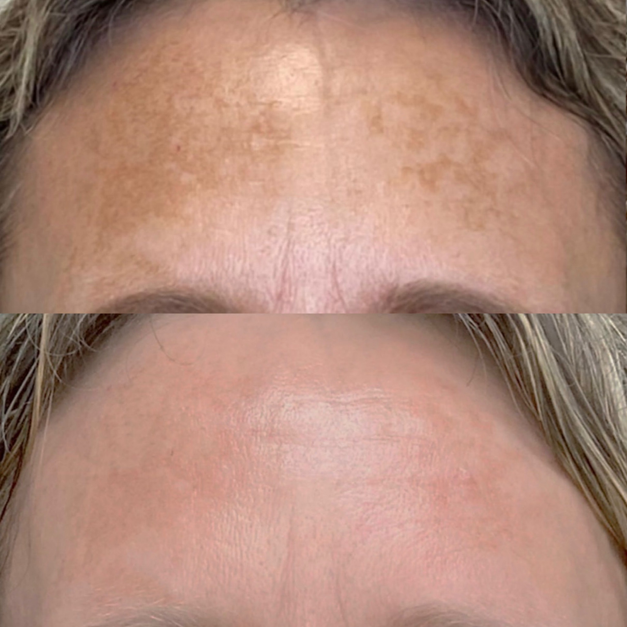 Cyspera® melasma kezelés eredmény