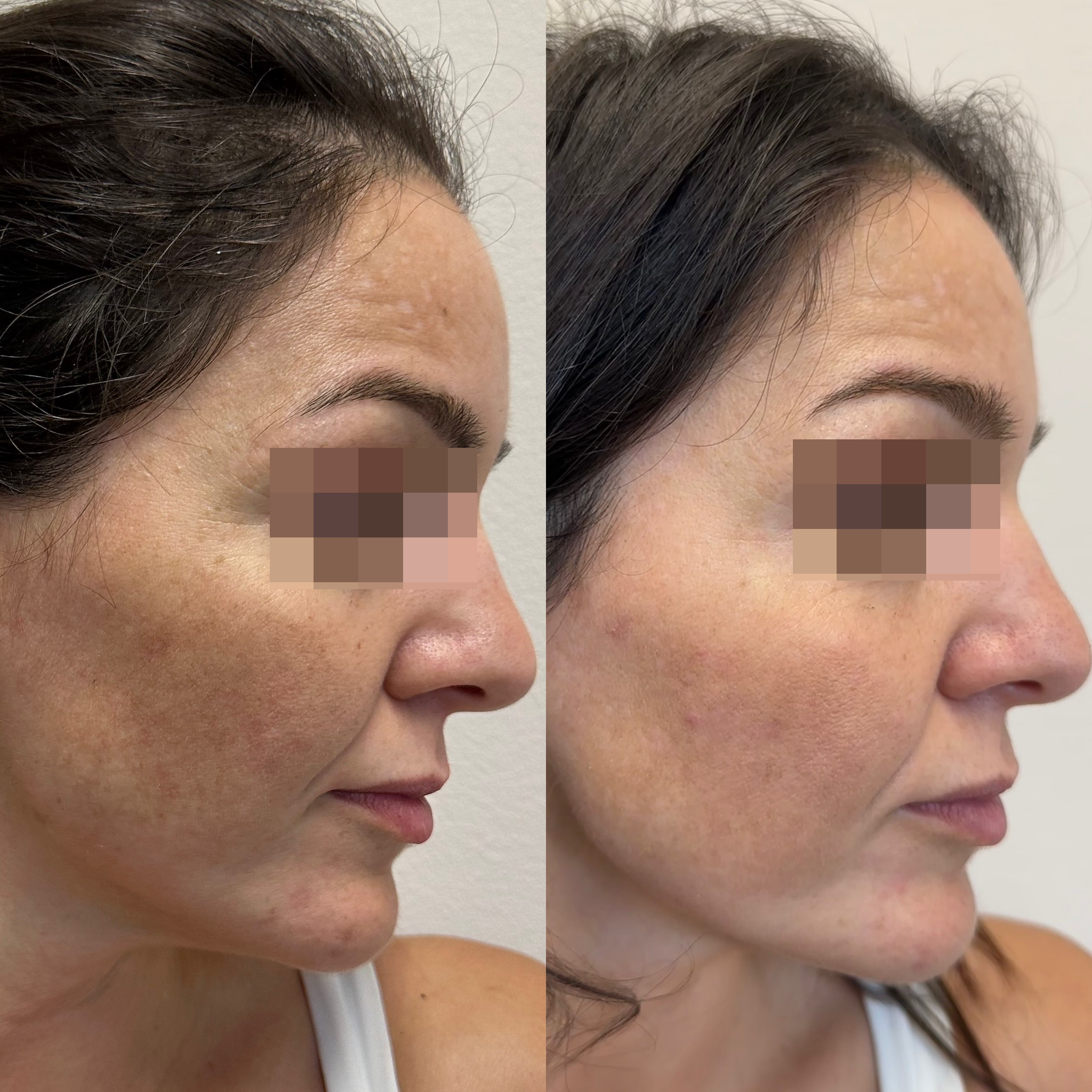 Cyspera® + PicoLO lézer melasma kezelés eredmény
